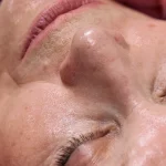 2024: RF Microneedling Benefits for Skin Rejuvenation - Before and After Results