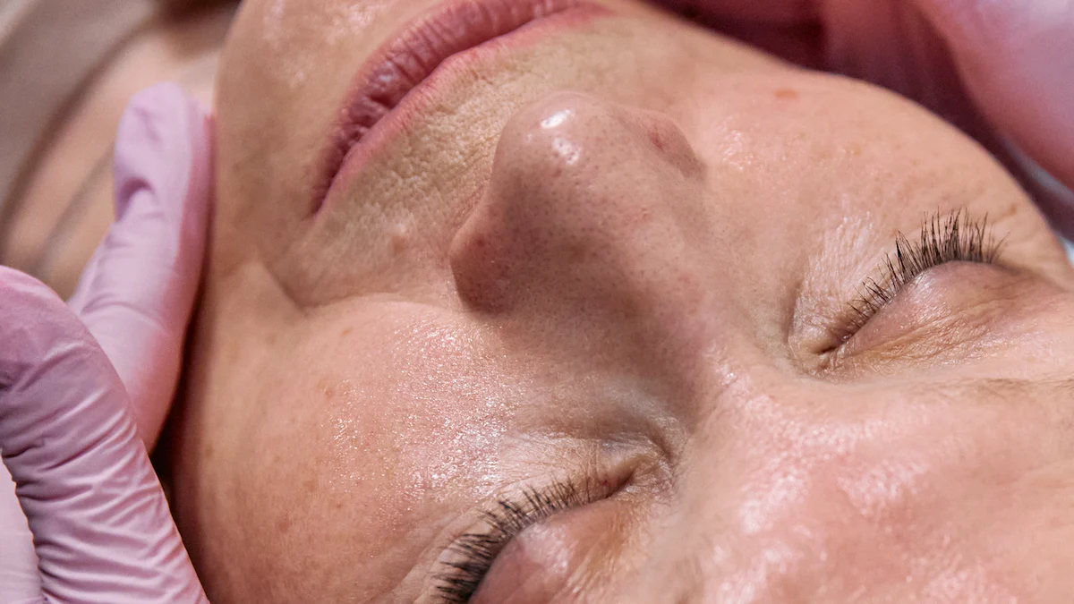 2024: RF Microneedling Benefits for Skin Rejuvenation - Before and After Results